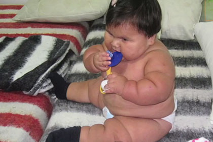Колумбийская девочка в 10 месяцев достигла веса пятилетнего ребенка