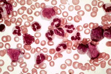 Раскрыт механизм перерождения клеток крови в рак