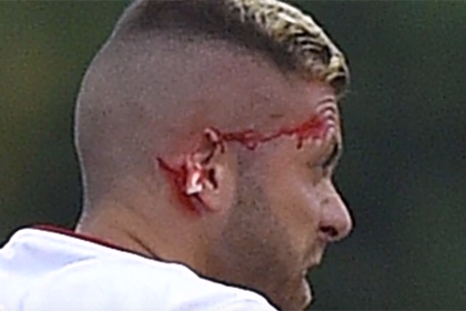 Футболист «Бордо» лишился части уха в товарищеском матче