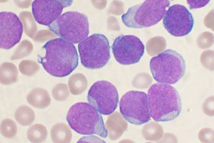 Рак крови научились лечить наночастицами