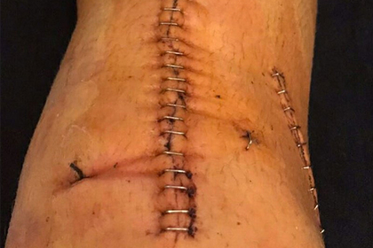 Футболист сборной России показал ногу после операции