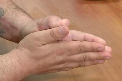 Американец отрезал палец на руке и заменил его пальцем ноги