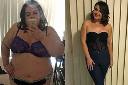 Австралийка удалила шесть килограммов кожи после похудения почти на центнер