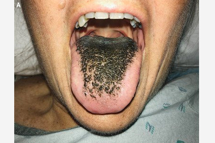 Антибиотики довели американку до черных волос на языке