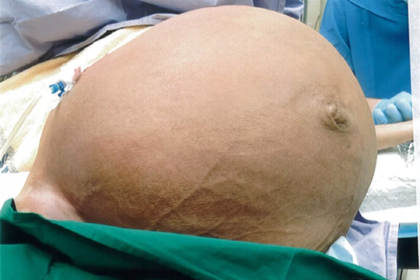 Вырастившая огромную опухоль женщина полгода терпела одышку из-за боязни врачей