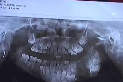 В Индии семилетнему мальчику удалили 80 зубов
