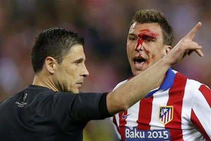 Футболисту «Атлетико» разбили лицо в матче Лиги чемпионов с «Реалом»