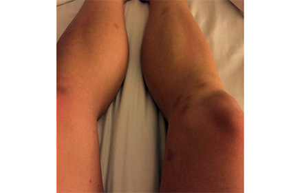 Бритни Спирс показала покрытые синяками ноги