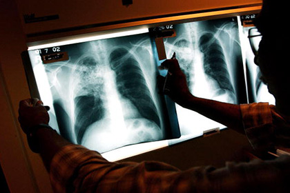 Российский туберкулез оказался самым смертоносным в мире