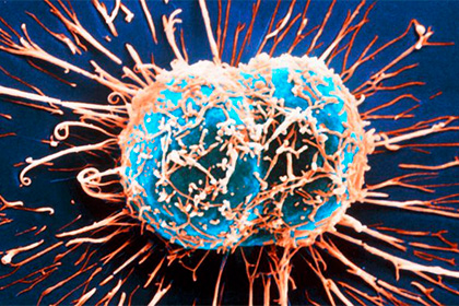 Рост смертоносной раковой опухоли объяснили математически