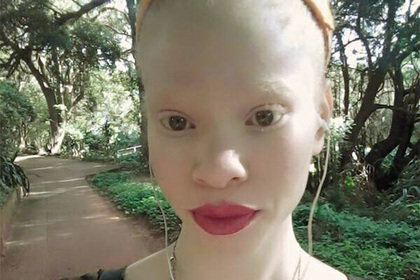 Подвергавшаяся издевательствам из-за альбинизма африканка стала моделью