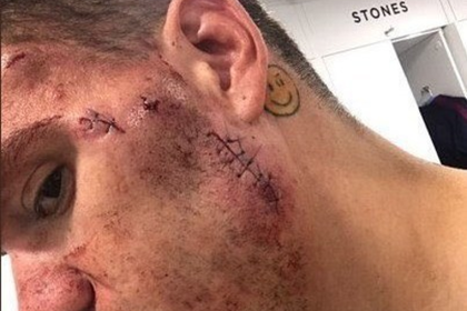 В сети ужаснулись шрамам нокаутированного ногой вратаря «Манчестер Сити»