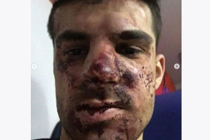 Избитый футболист «Зенита» раскрыл подробности инцидента