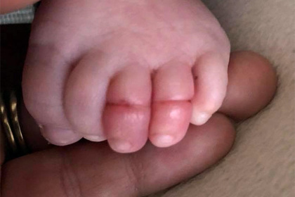 Младенец почти лишился пальцев ног из-за волос матери