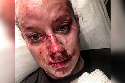 Девушка-полицейский показала окровавленное лицо после драки и прославилась