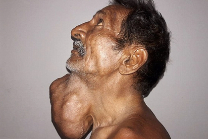 Фермер 20 лет откладывал поход к врачу и заработал опухоль размером с голову